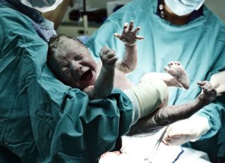 Kind wird durch Kaiserschnitt geboren